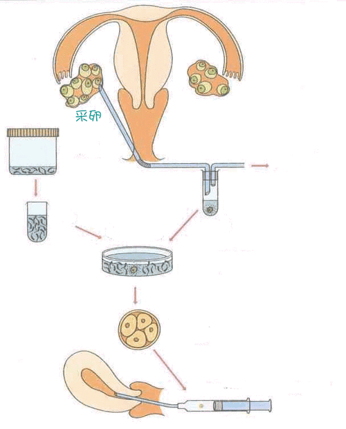 试管代怀的原理_试管代怀原理解析- 人工受精与胚胎移植技术